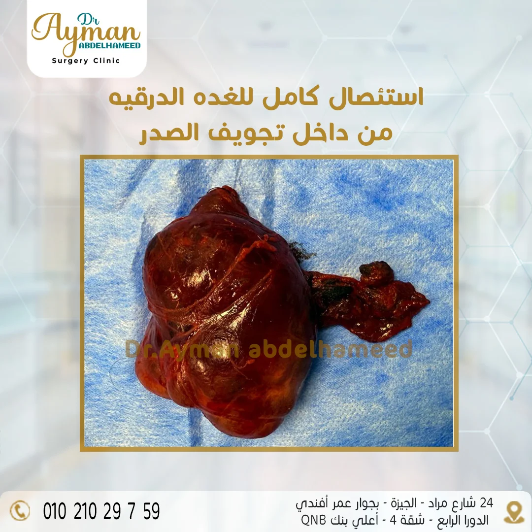 Read more about the article استئصال كامل للغدة الدرقية من داخل تجويف الصدر