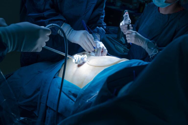Read more about the article Renal cell carcinoma in the era of minimally invasive surgery