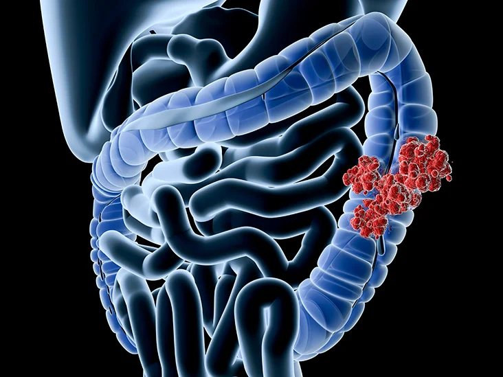 You are currently viewing The most updated colectomy techniques in the surgical management of colon cancer