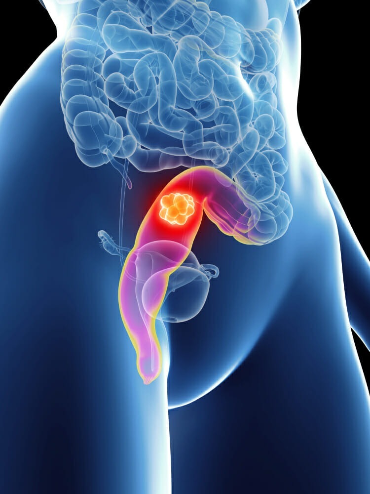 Read more about the article Laparoscopic Approach to Rectal Cancer—The New Standard?