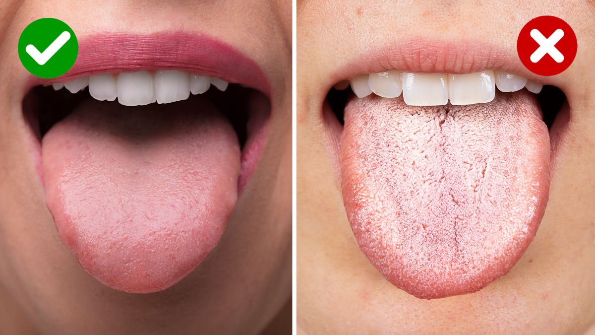 You are currently viewing Why is tongue cancer on the rise?