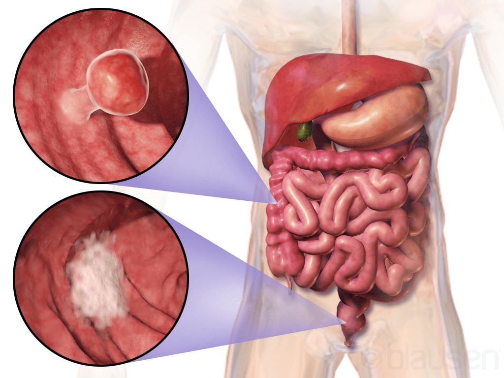 You are currently viewing Colon Cancer