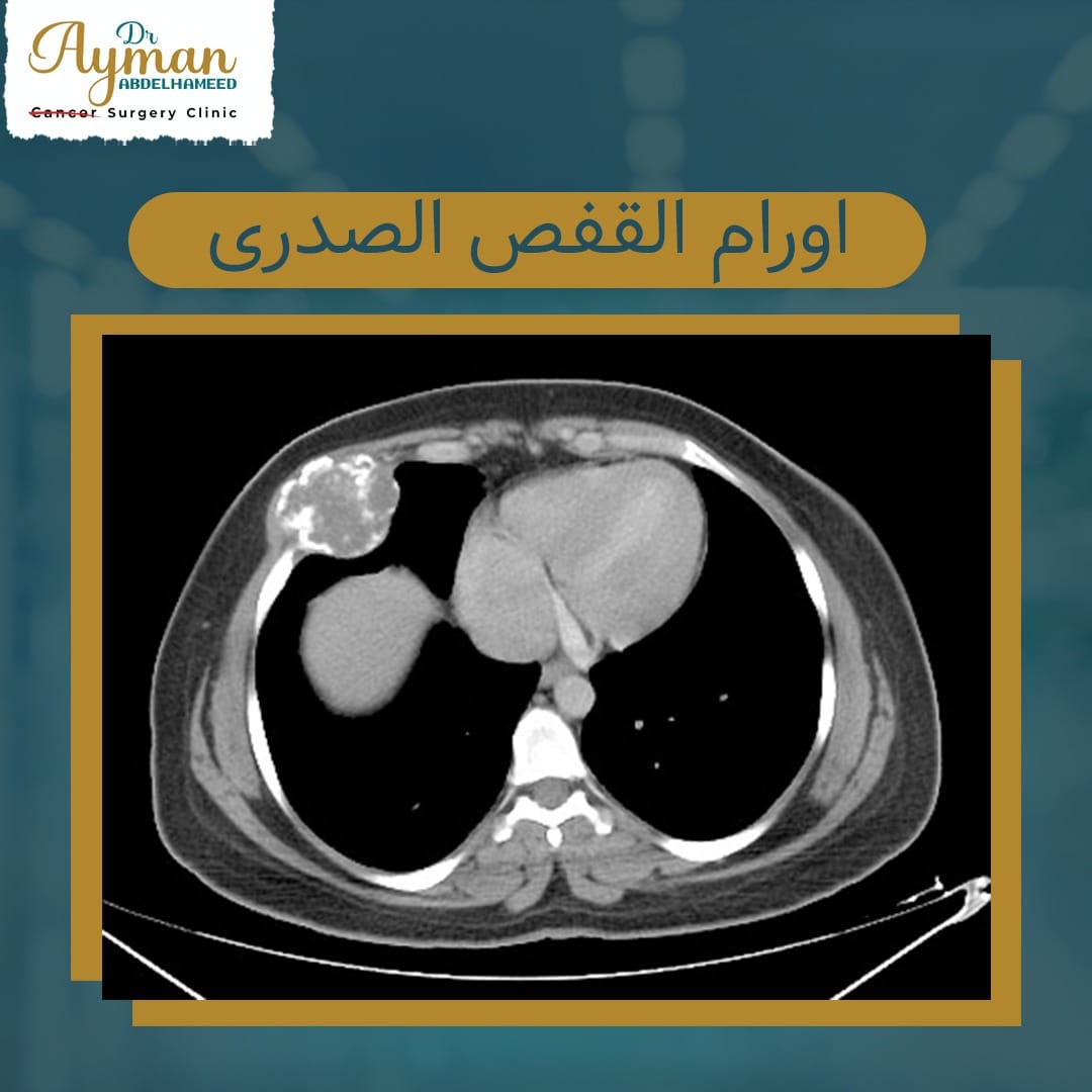 You are currently viewing Tumors of the rib cage and ribs