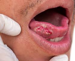 Read more about the article سرطان اللسان – خطة العلاج المناسبة لكل مريض ؟