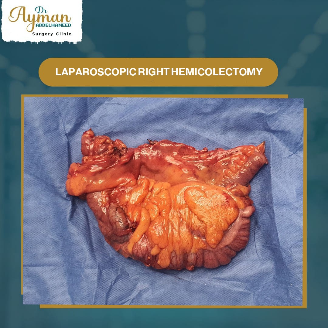 You are currently viewing Laparoscopic right hemicolectomy