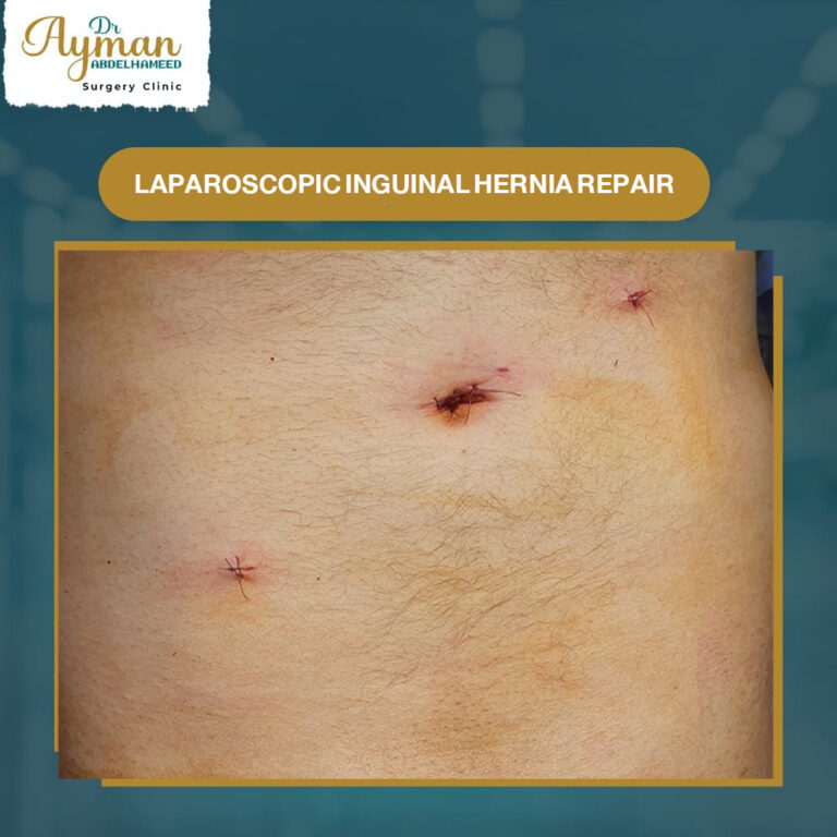 Read more about the article laparoscopic inguinal hernia repair