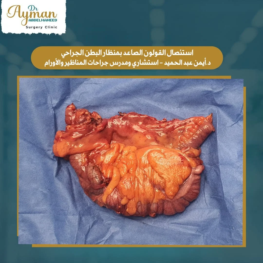 Read more about the article استئصال القولون الصاعد بمنظار البطن الجراحي
