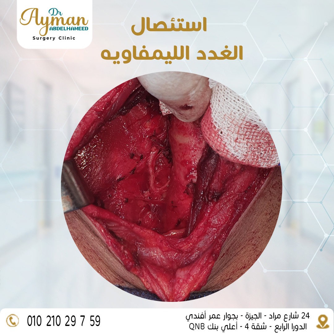You are currently viewing Central and Lateral neck dissection