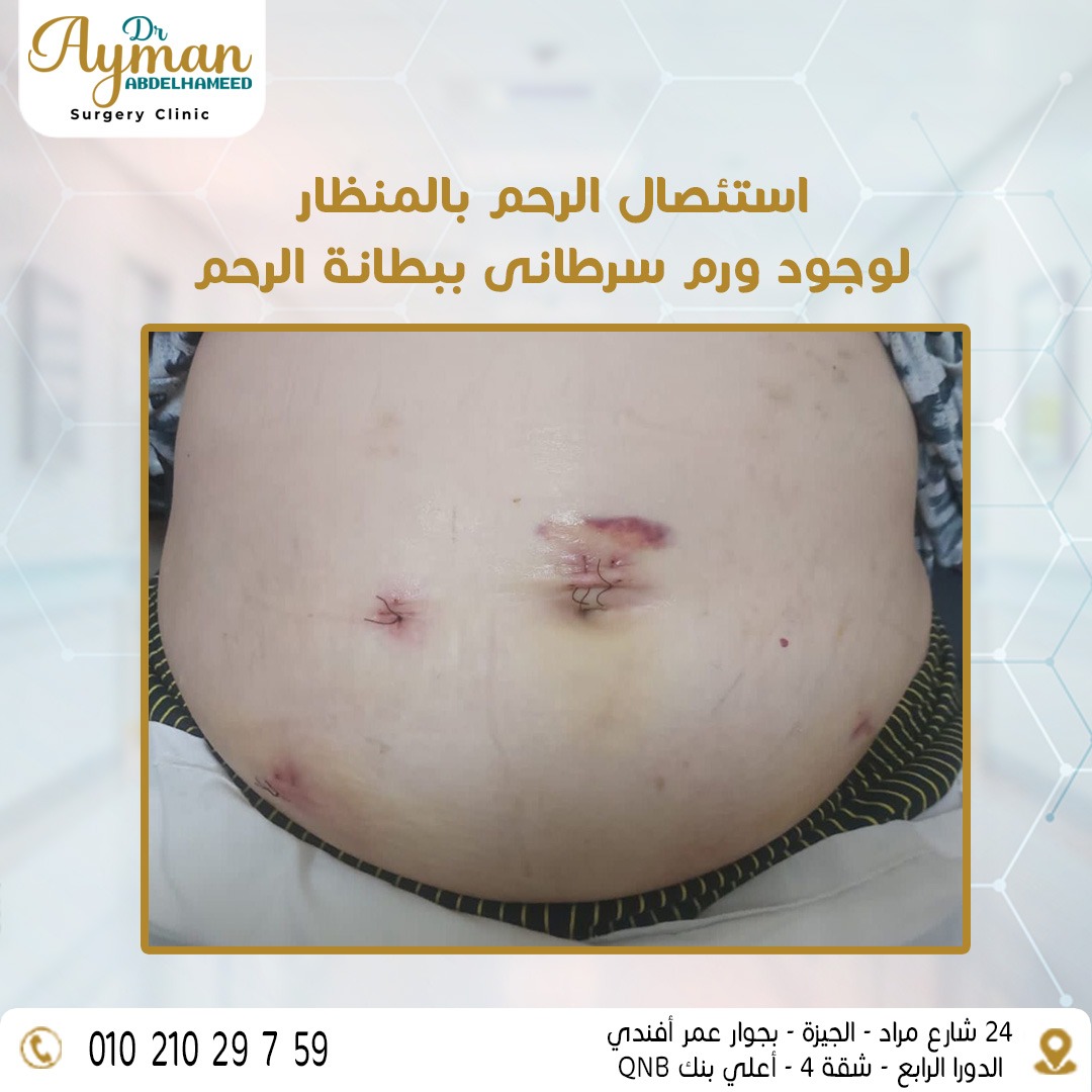 You are currently viewing استئصال الرحم بالمنظار