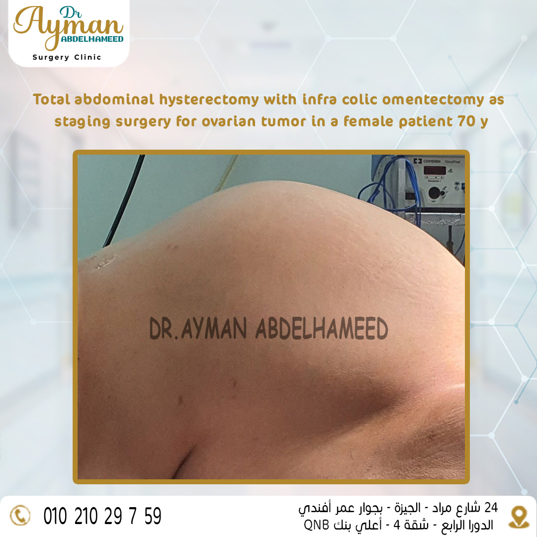 You are currently viewing Success Total abdominal hysterectomy