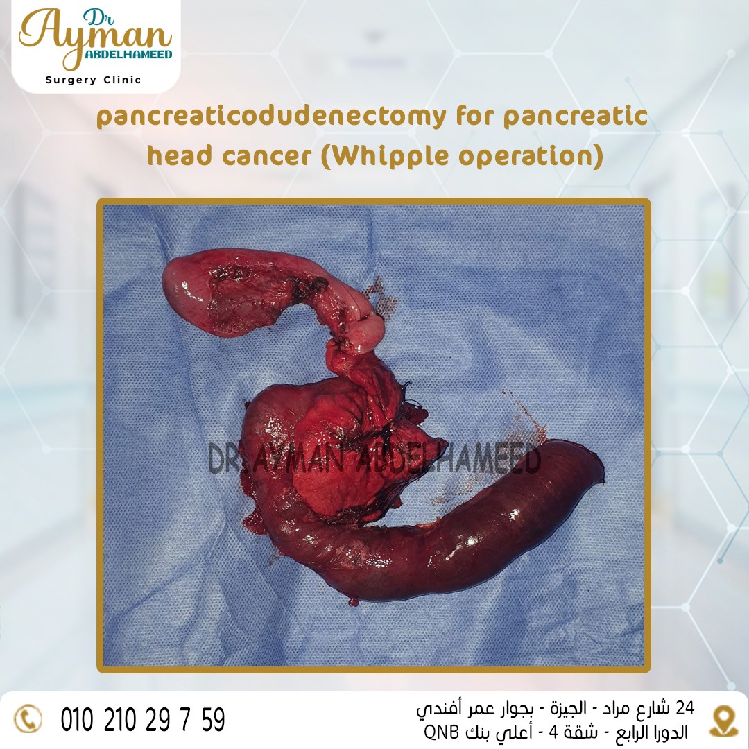 You are currently viewing pancreaticodudenectomy for pancreatic head cancer