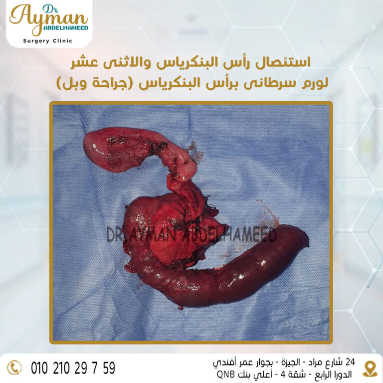 Read more about the article استئصال رأس البنكرياس والاثنى عشر (جراحة وبل)