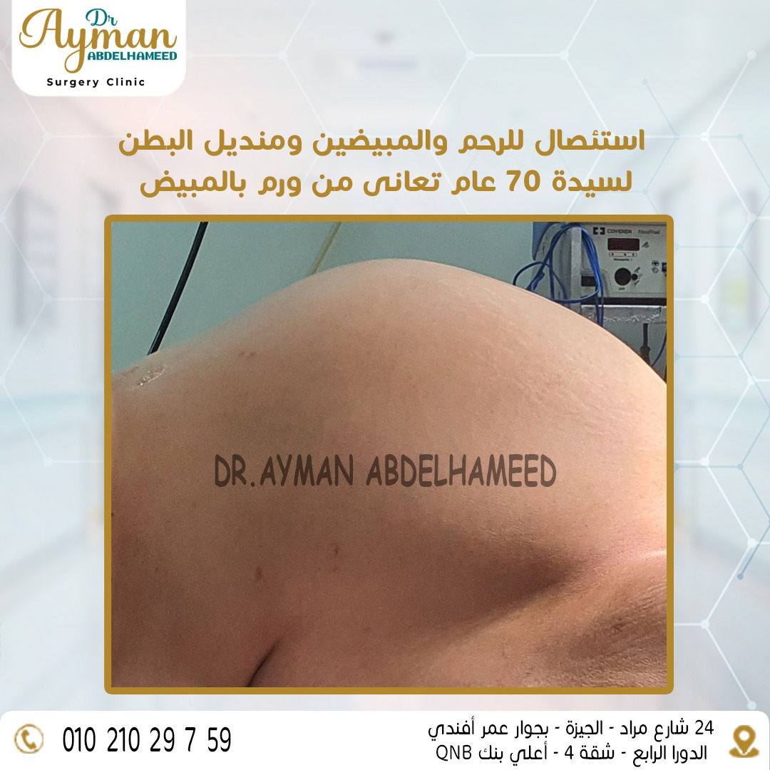 You are currently viewing نجاح عملية استئصال للرحم والمبيضين ومنديل البطن