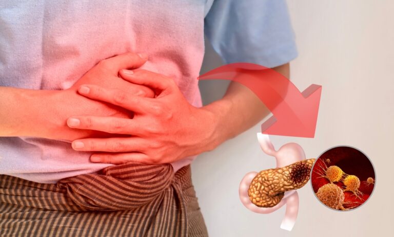 Read more about the article مضاعفات سرطان البنكرياس