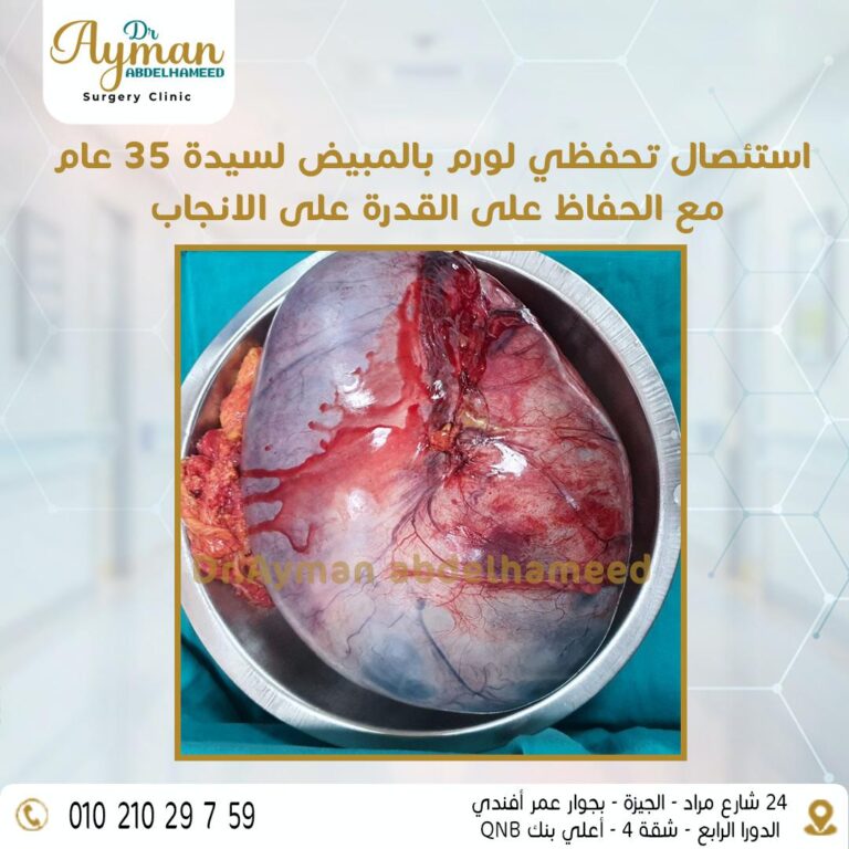 Read more about the article استئصال تحفظي لورم بالمبيض لسيدة ٣٥ عام مع الحفاظ على القدرة على الانجاب