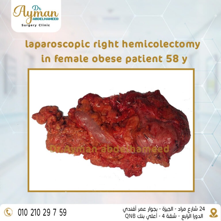 Read more about the article laparoscopic right hemicolectomy