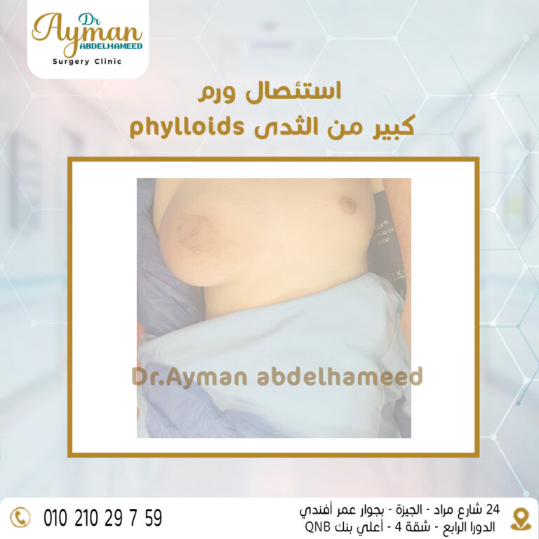 Read more about the article ما هي أورام الثدى 