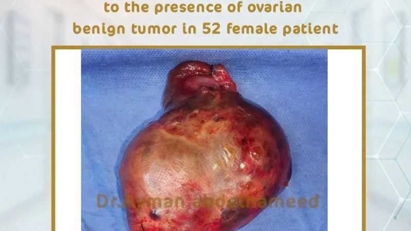 Salpinooopherctomy for tortion ovary