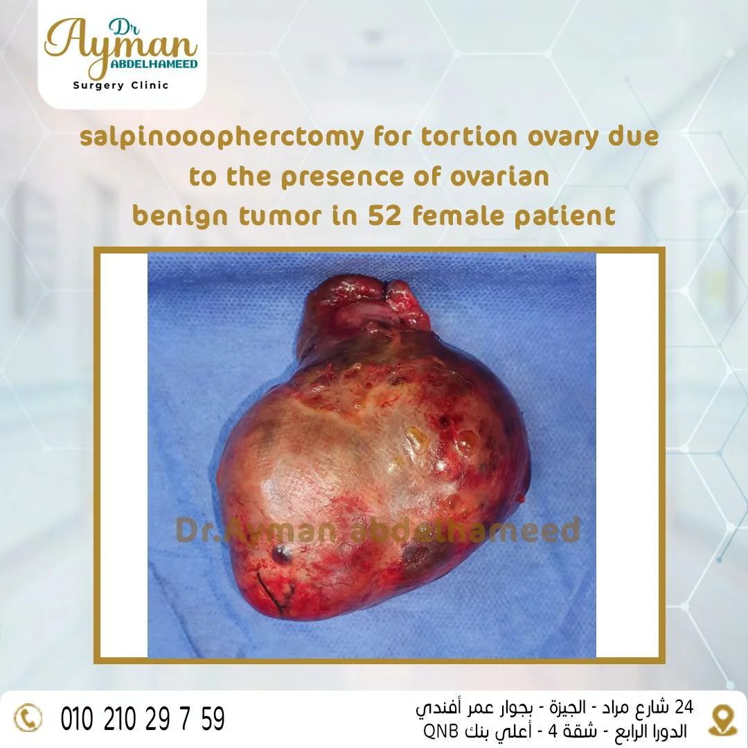 You are currently viewing Salpinooopherctomy for tortion ovary