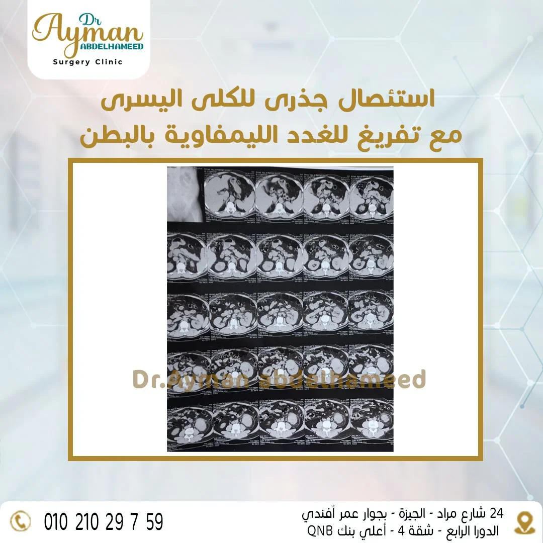 Read more about the article استئصال جذرى الكلى اليسرى