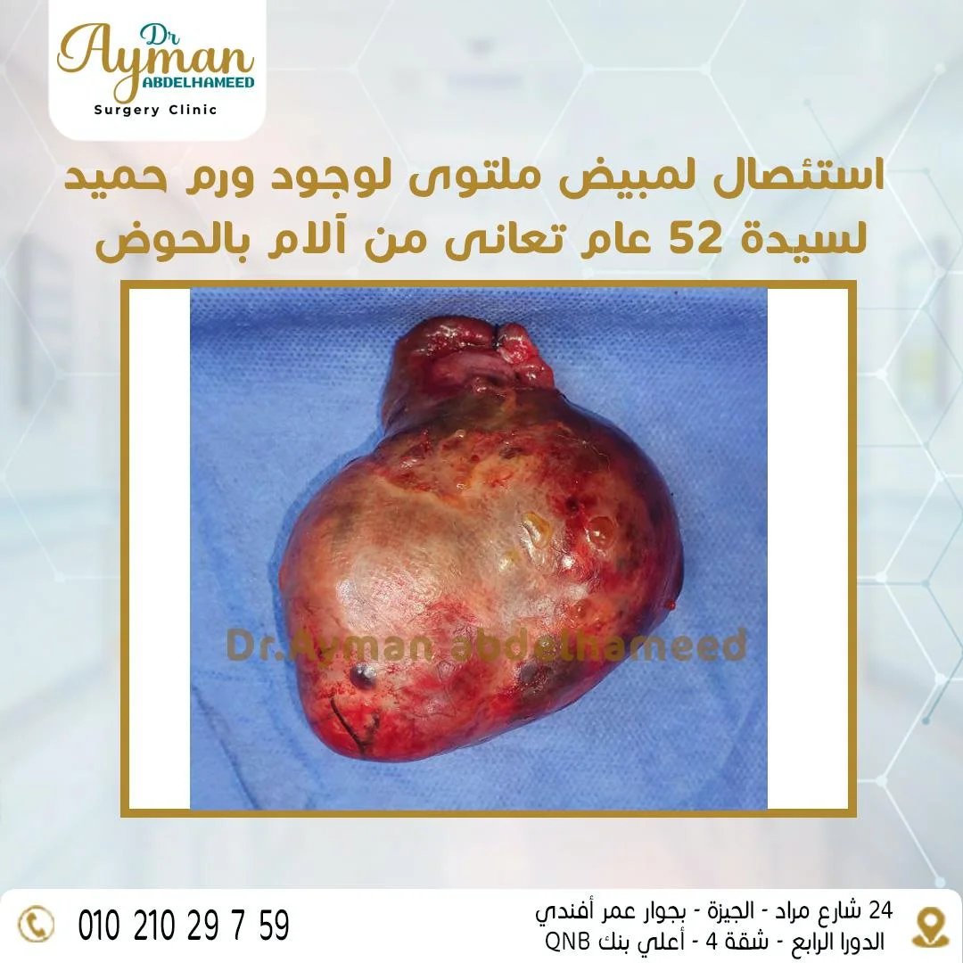 Read more about the article استئصال مبيض ملتوى لوجود ورم حميد
