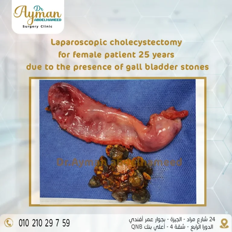 Read more about the article Laparoscopic cholecystectomy