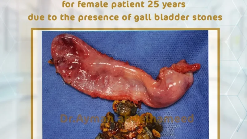 Laparoscopic cholecystectomy