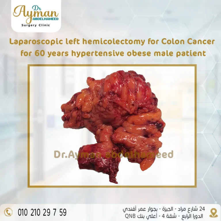 Read more about the article Laparoscopic left hemicolectomy for Colon Cancer