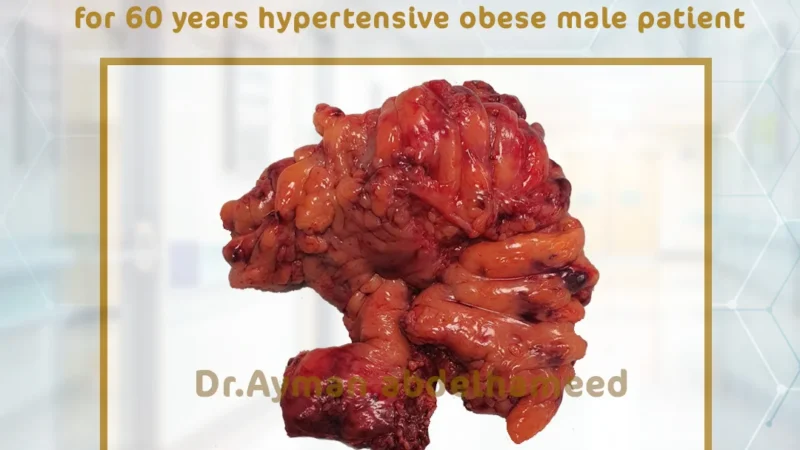 Laparoscopic left hemicolectomy for Colon Cancer