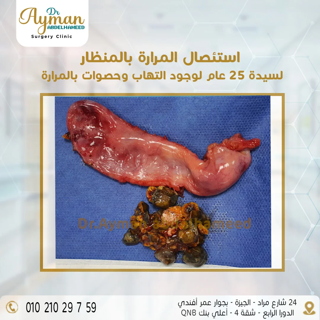 You are currently viewing نجاح عملية استئصال المرارة بالمنظار