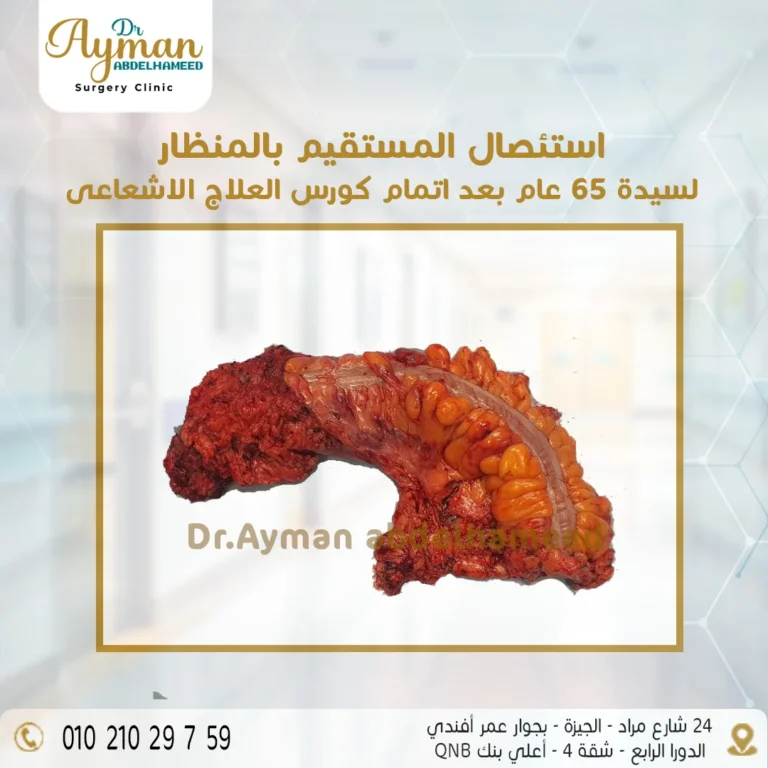 Read more about the article عملية استئصال المستقيم بالمنظار
