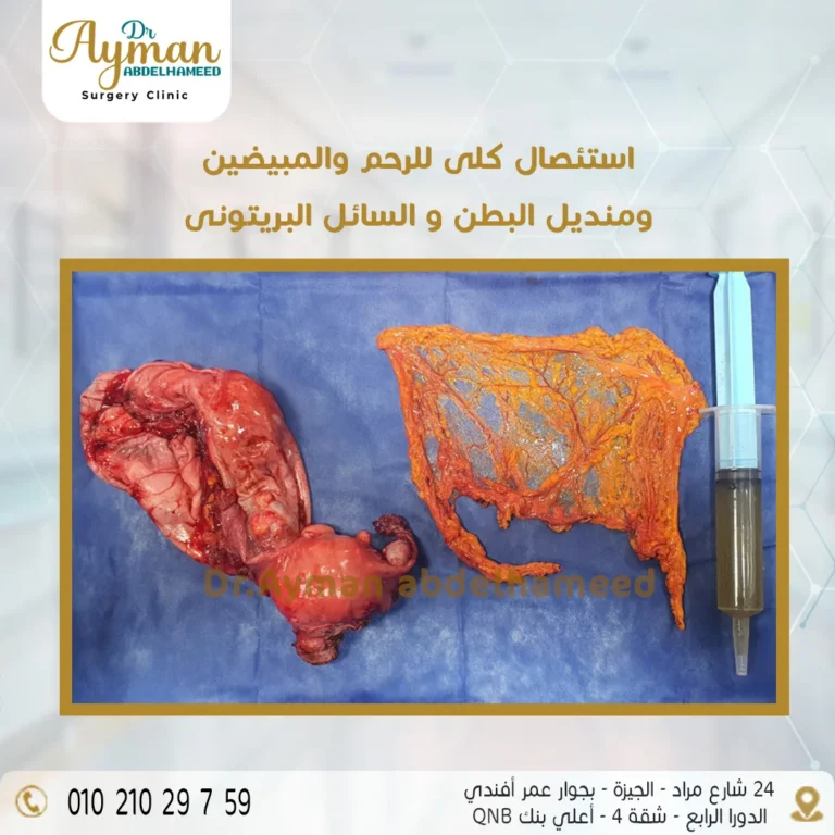 Read more about the article نجاح عملية استئصال كلي للرحم والمبيضين ومنديل البطن و السائل البريتونى