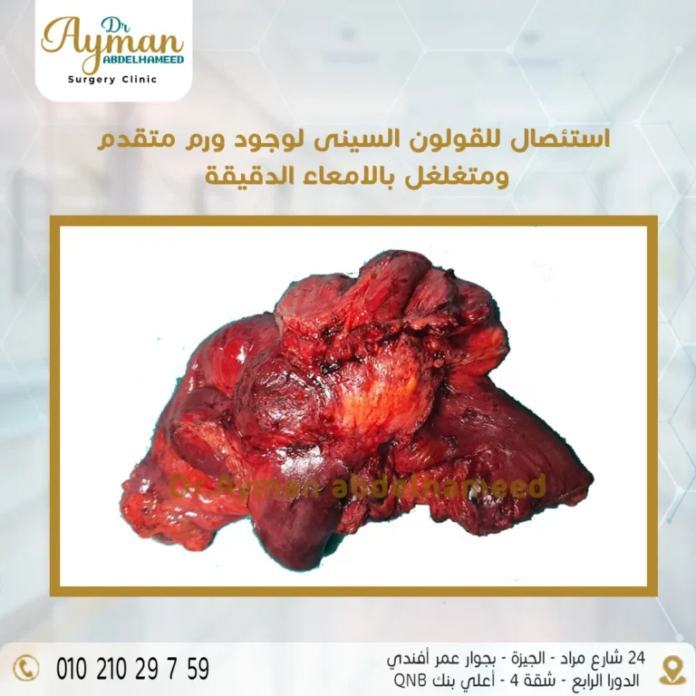 Read more about the article استئصال للقولون السينى لوجود ورم متقدم ومتغلغل بالامعاء الدقيقة