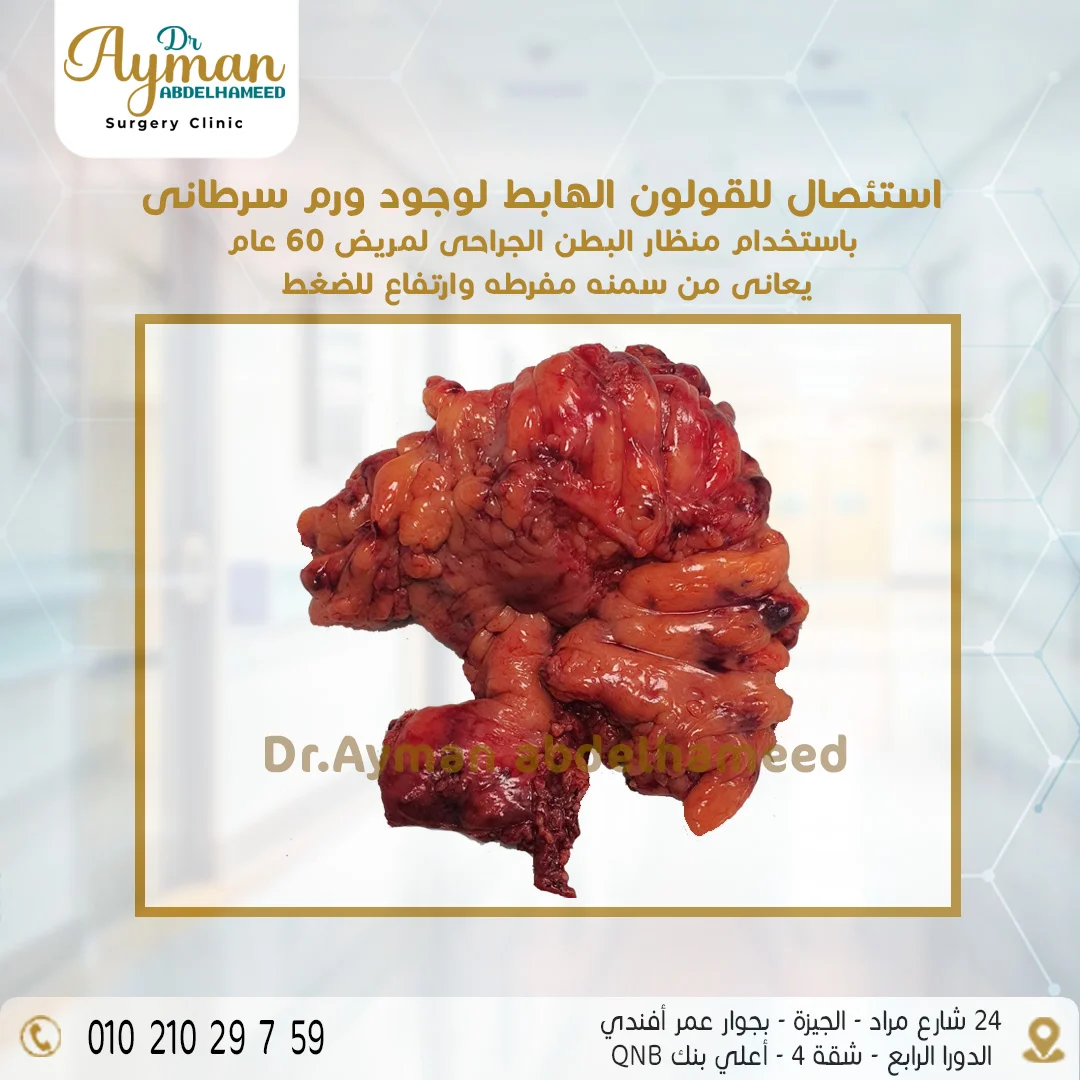 You are currently viewing استئصال للقولون الهابط لوجود ورم سرطانى