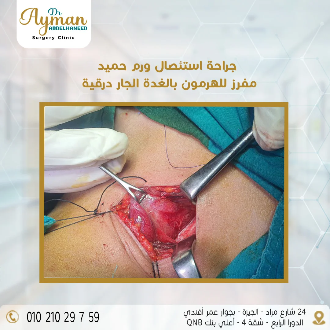 You are currently viewing جراحة استئصال ورم حميد مفرز للهرمون بالغدة الجار درقية