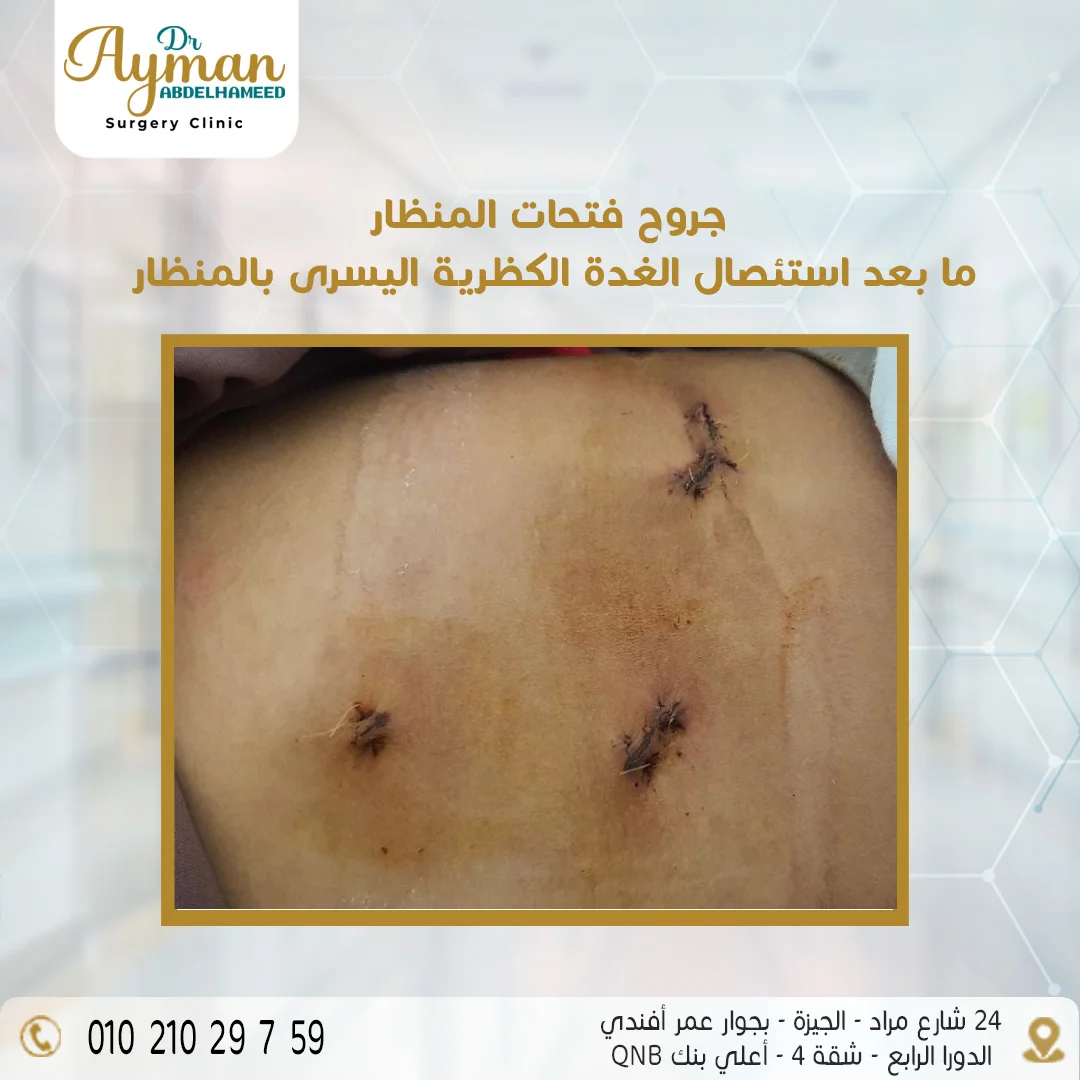 Read more about the article جروح فتحات المنظار ما بعد استئصال الغدة الكظرية اليسرى بالمنظار