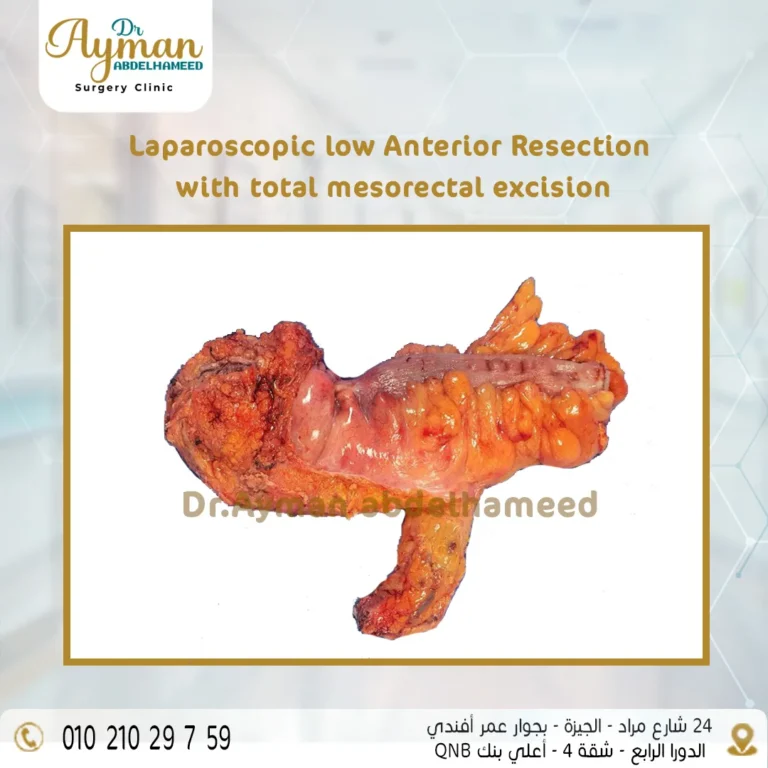 Read more about the article Successful laparoscopic resection of the rectum and its surrounding covering