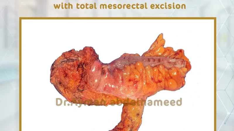 Successful laparoscopic resection of the rectum and its surrounding covering