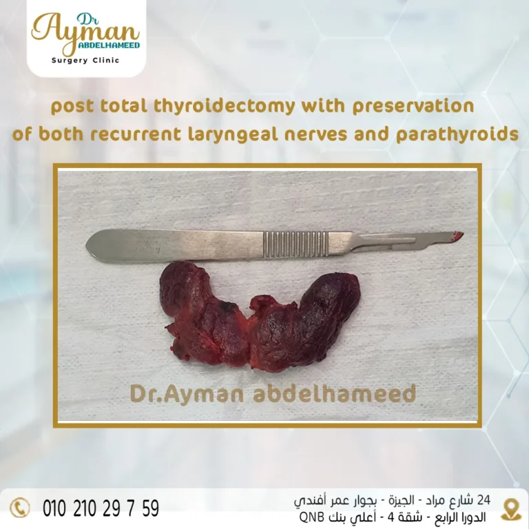 Read more about the article Successful post total thyroidectomy with preservation of both recurrent laryngeal nerves and parathyroids