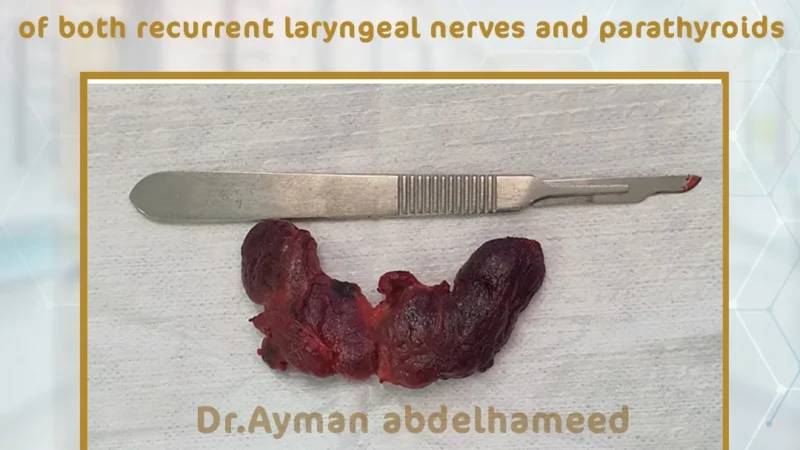 Successful post total thyroidectomy with preservation of both recurrent laryngeal nerves and parathyroids