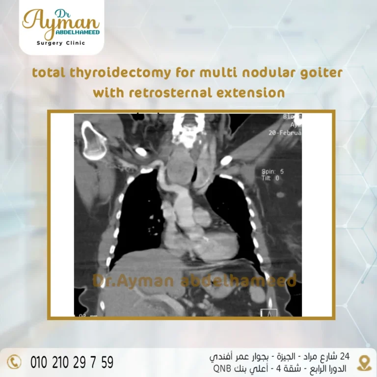 Read more about the article Successful surgery to remove enlarged thyroid gland in the neck