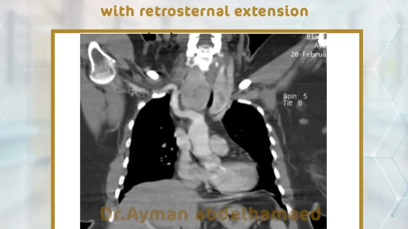 Successful surgery to remove enlarged thyroid gland in the neck