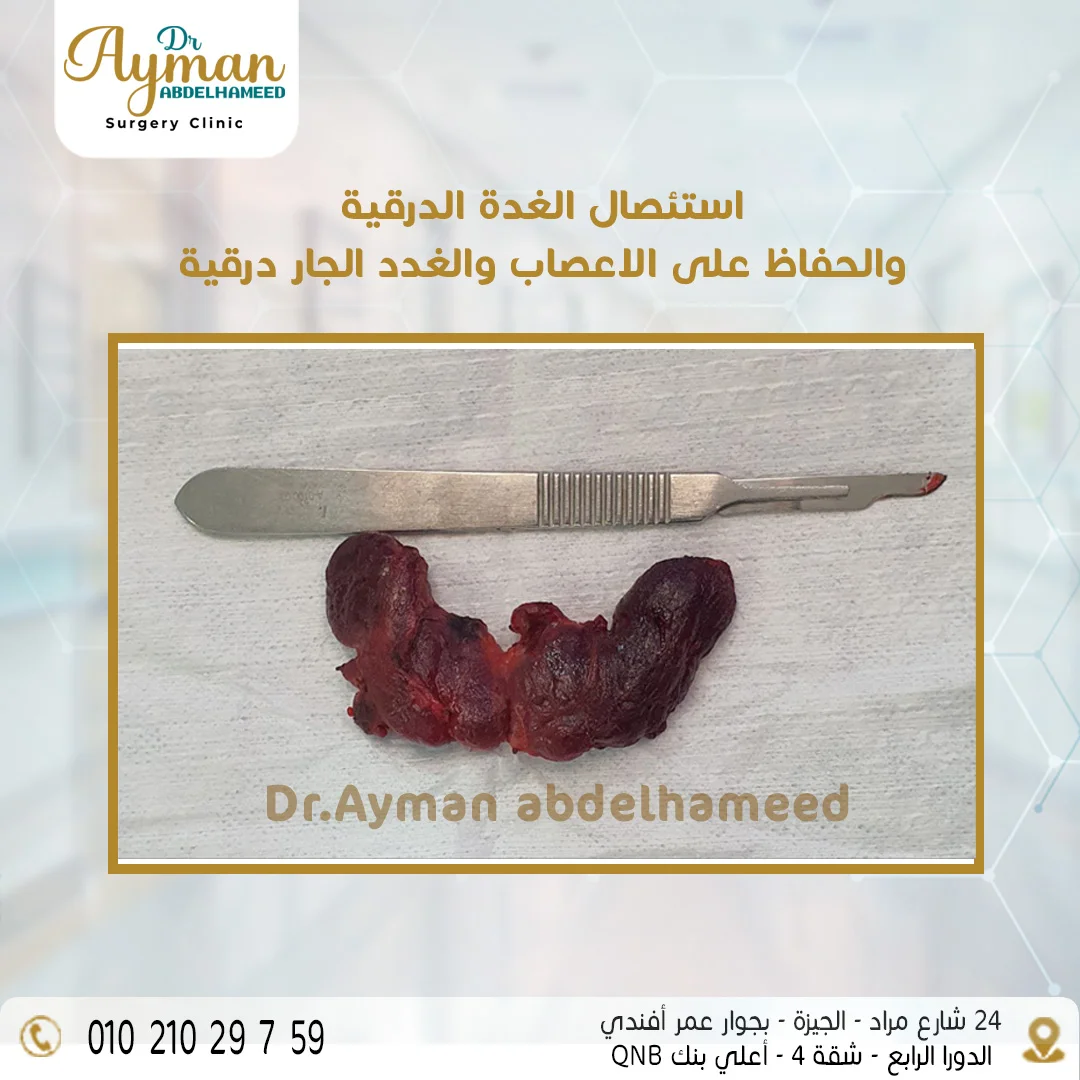 Read more about the article نجاح استئصال الغدة الدرقية والحفاظ على الأعصاب الغدد الجار درقية