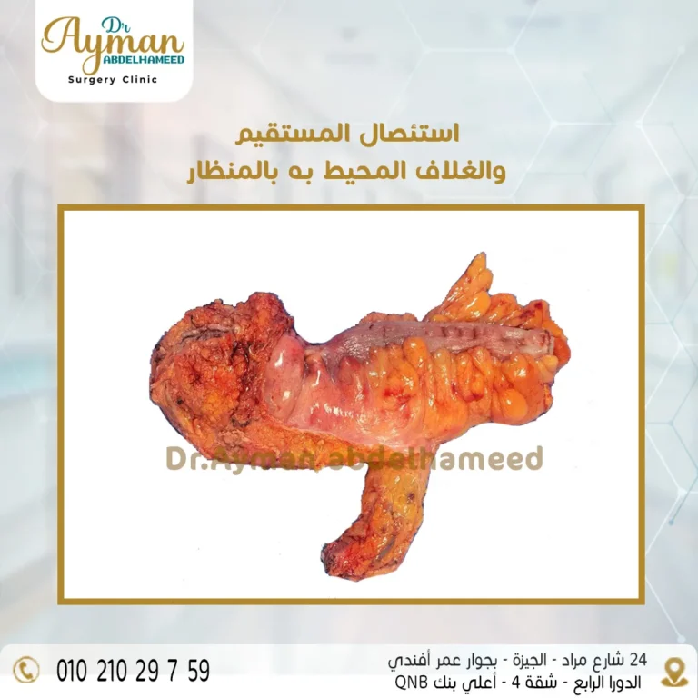 Read more about the article نجاح استئصال المستقيم والغلاف المحيط به بالمنظار