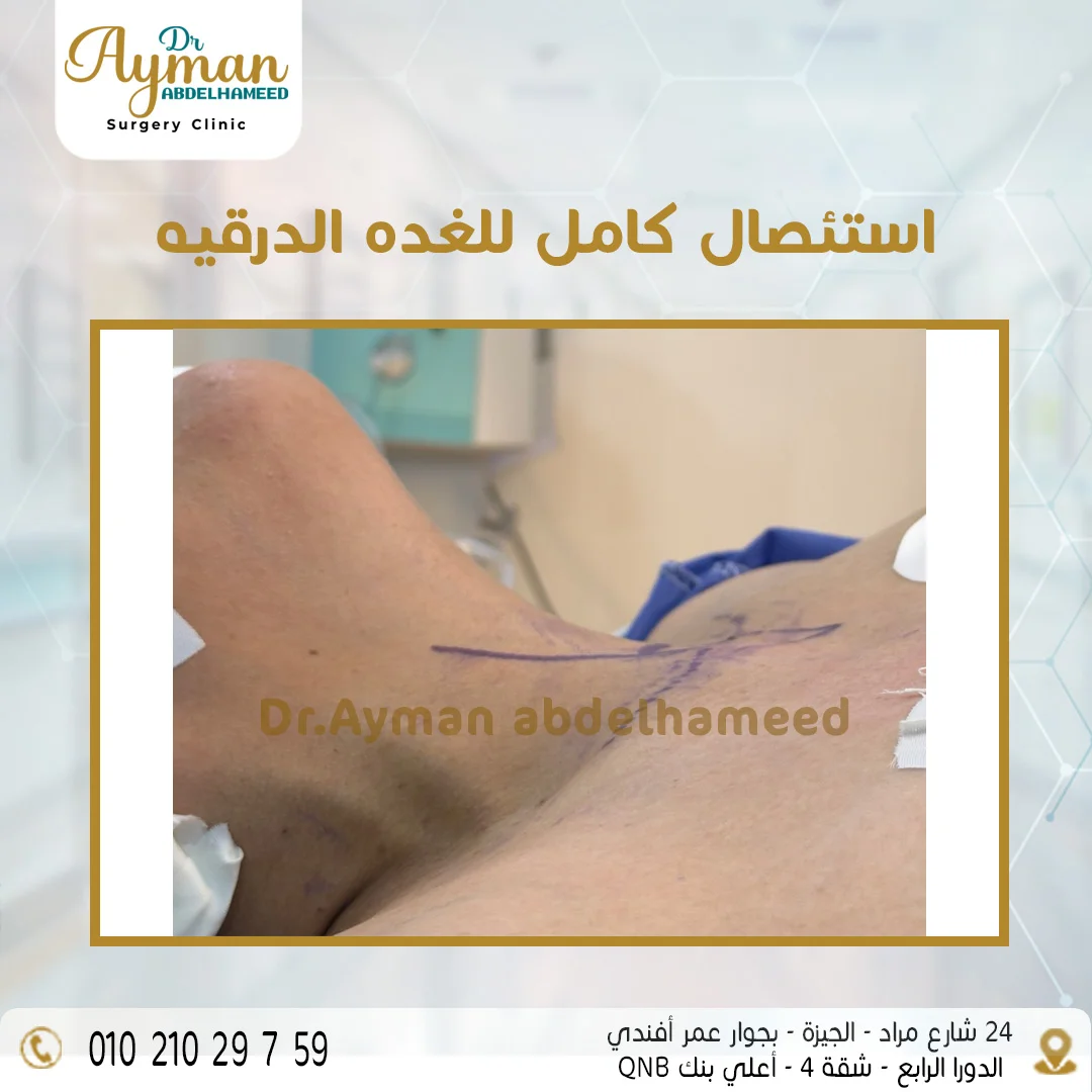 Read more about the article استئصال كامل للغده الدرقيه