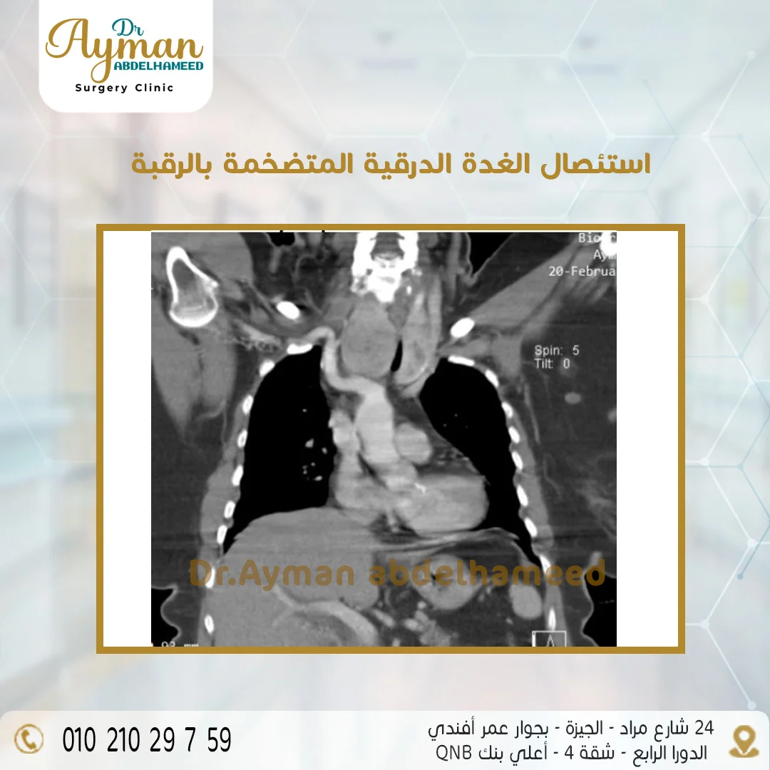 You are currently viewing نجاح عملية استئصال الغدة الدرقية المتضخمة بالرقبة