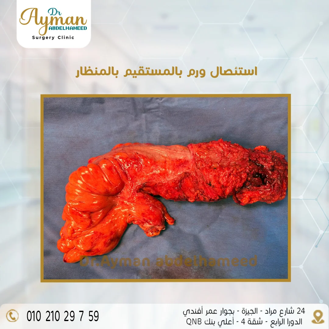 You are currently viewing استئصال ورم بالمستقيم بالمنظار