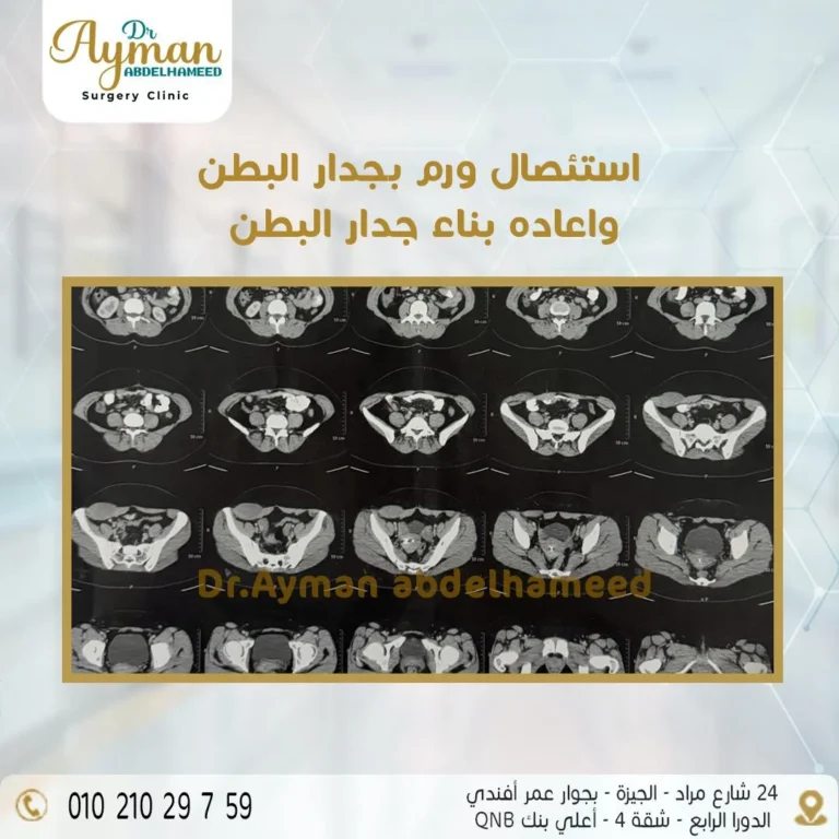 Read more about the article استئصال ورم بجدار البطن