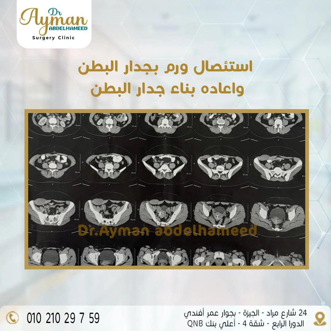 Read more about the article استئصال ورم بجدار البطن
