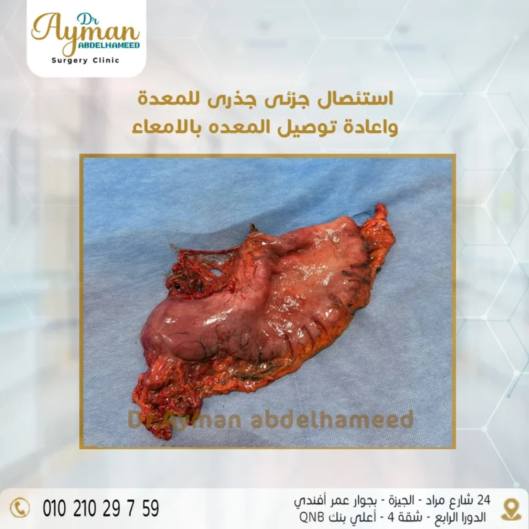 Read more about the article نجاح استئصال جزئى جذرى للمعدة